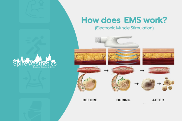 EMS treatment for post pregnancy weight loss treatment Ravensthorpe