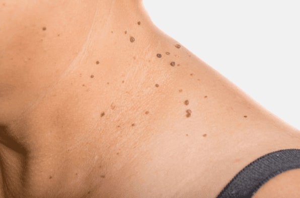 Are you looking for easy skin tag removal Ravensthorpe - then contact Spire today!