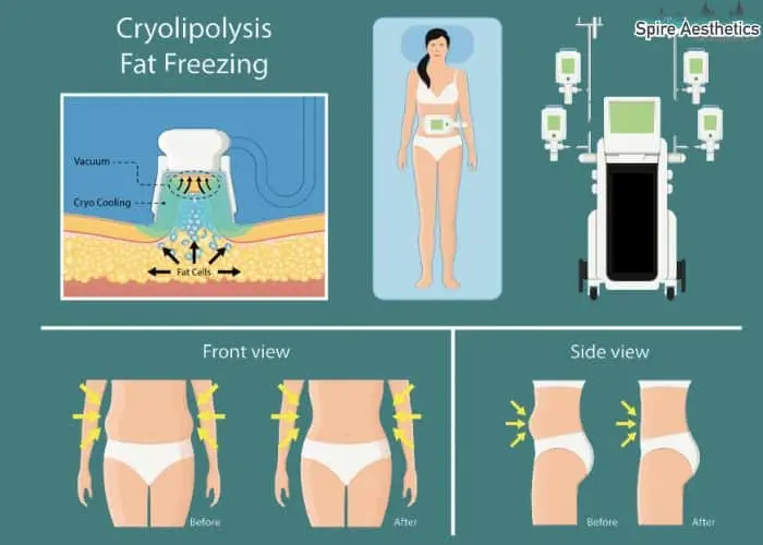 Fat freezing treatment Ravensthorpe benefits for competitions to remove stubborn fat deposits.