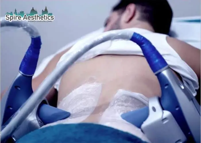 Man having fat freezing treatment done on love handles before a competitions Ravensthorpe to create a sculpted look.