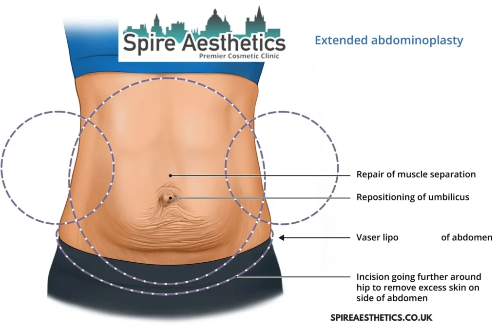 Understanding Loose Skin After Gastric Band Ravensthorpe Surgery and HIFU Treatment