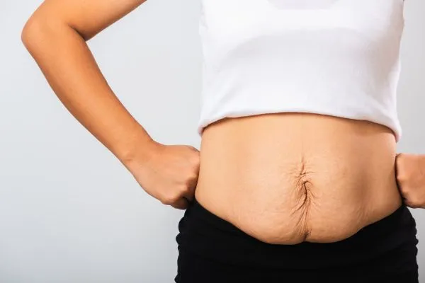 Image of a woman's stomach after weight loss with sagging skin following a gastric band Ravensthorpe