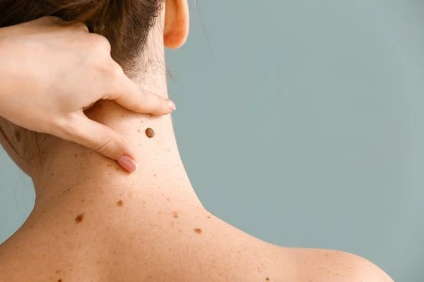 skin blemish removal Ravensthorpe treatment