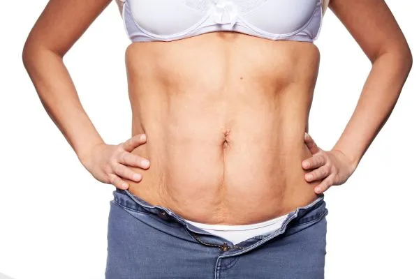 sagging skin on woman's stomach after weight loss injections Ravensthorpe