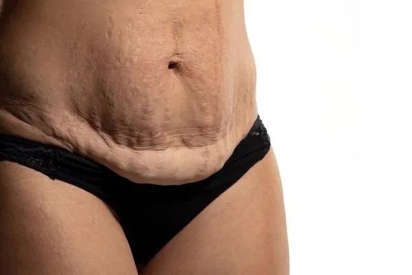 Image of womans stomach after weight loss injections Ravensthorpe showing saggy skin