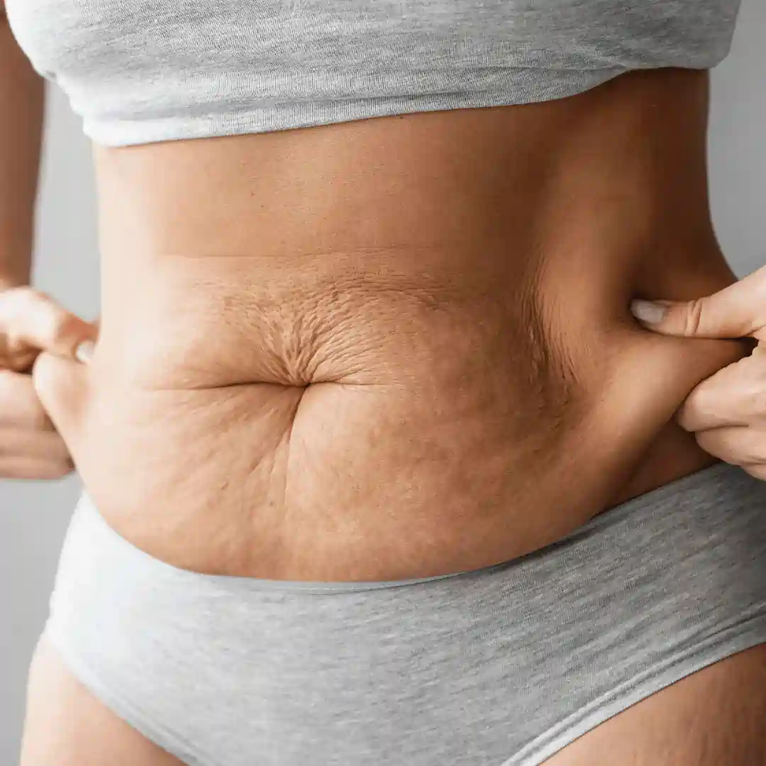 Is It Normal to Have Loose Skin After Pregnancy Ravensthorpe?